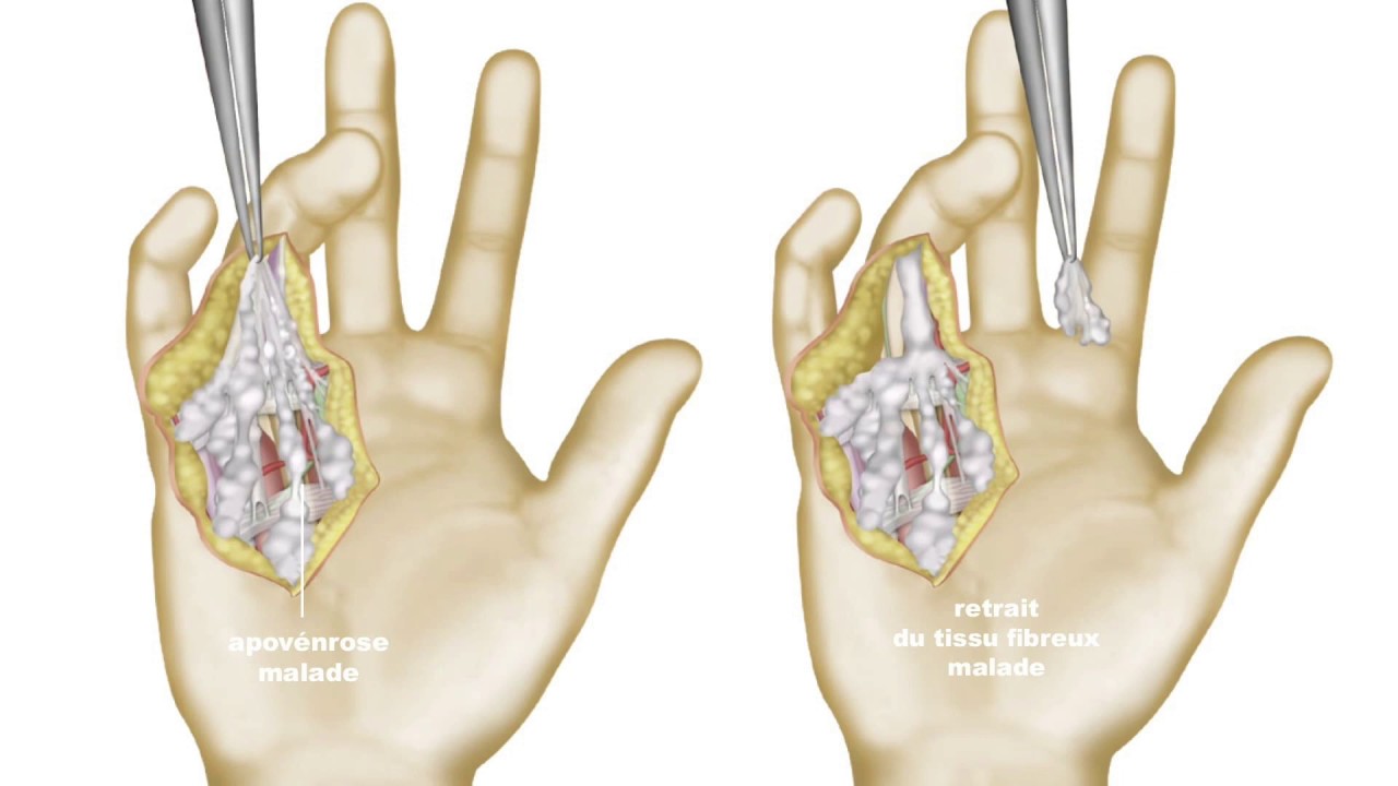 Maladie de Dupuytren : guérison et traitement naturel ou chirurgical