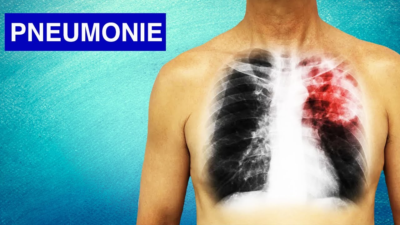 Pneumonie : Symptômes, Diagnostic et Traitements